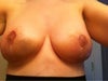 BOTH BREASTS -  3 weeks post op