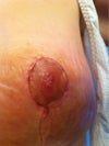 LEFT BREAST - NICELY HEALING, 3 weeks post op