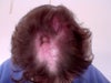 bald spot