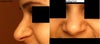 Nose when smiling