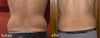 before-after back