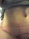one week post op