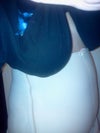two weeks post op. swelling of abdomen.