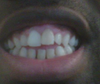 You will notice discoloration of the protruding left front tooth