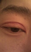 Right eye