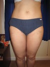 14 days Post-OP