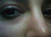 redness and swelling under right eye