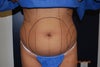 Front pic before lipo