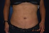 Front pic after lipo