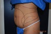 Side shot before lipo