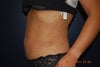 Side shot after lipo