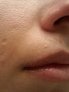 right side (slight ptosis/asymmetry)