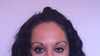 droopy eyelid from botox