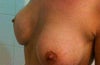 Side view- right breast looks flat