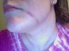 laser vein treatment scar