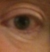 Deep double lines under eyes