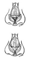 Alar spreader graft