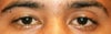 This is my eyelids BEFORE any operation was performed