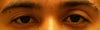 This is after surgery was done on the LEFT eyelid