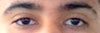 This is what they currently look like, 8 months after my second operation on Right eyelid