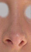 Strange swelling/bulging under nostrils, a line/(feels like a ridge) of bone/swelling/shadow down the bridge on one side (not too apparent from this close up - more apparent at a distance)