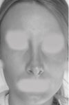 Overall appearance not good. Can't decide what is making me look worse - bridge is wider than before (was thin and quite sharp), is this swelling? Ridge/shadow more apparent here - worst is probably the (swelling?) around nostrils. Will this subside or stay like this?