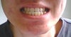 front teeth