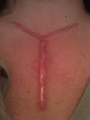 My incision scar 9 months out.