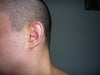 Left ear, 1 week after assault and surgery, stitches just removed.