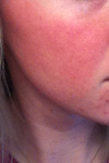 Notice the difference between my face and my neck (which is NORMAL skin color).
