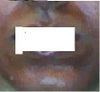 At 11th day of the peel after peeling process.