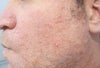 3 days post treatment