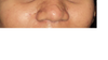 Picture of acne