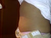 bulge in upper abdomen. gets worse after eating and as  the day goes on