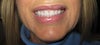 Jan 4, 2010 lip injected pic 2