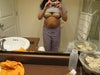 BEFORE TUMMY TUCK