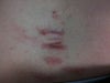 Keloids (sternum)