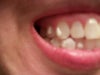 He removed one veneer which aligned the bottom teeth, then added all these white ugly buttons.  Don't they have clear buttons?