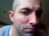 Areas treated are center of cheek with recent bruising and swelling over upper cheek bone.