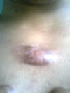 CHEST KELOIDS