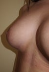 right breast