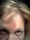 Forehead bruise