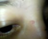 box scar on right side of nose between eyes