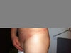 2 weeks with bruising and red rash