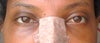 right eye with a line of lump