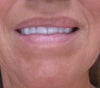 Here is a profile of my upper left lip as of 4/21/11....hate it!!!