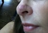 Side view of the nose - pink & swollen