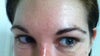 Now -  several wrinkles and folds under the eye despite small does of botox to assist with lower lid appearance.