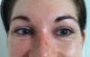 Now -  multiple pleats and poor skin quality (excess skin?) under eyes. Purple line through tear trough  obvious in person but does not show up in photos as much.