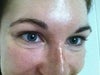 The doctors have pointed out that a non-flash clinical photo pre-treatment would be helpful. this is actually my clinical before photo.